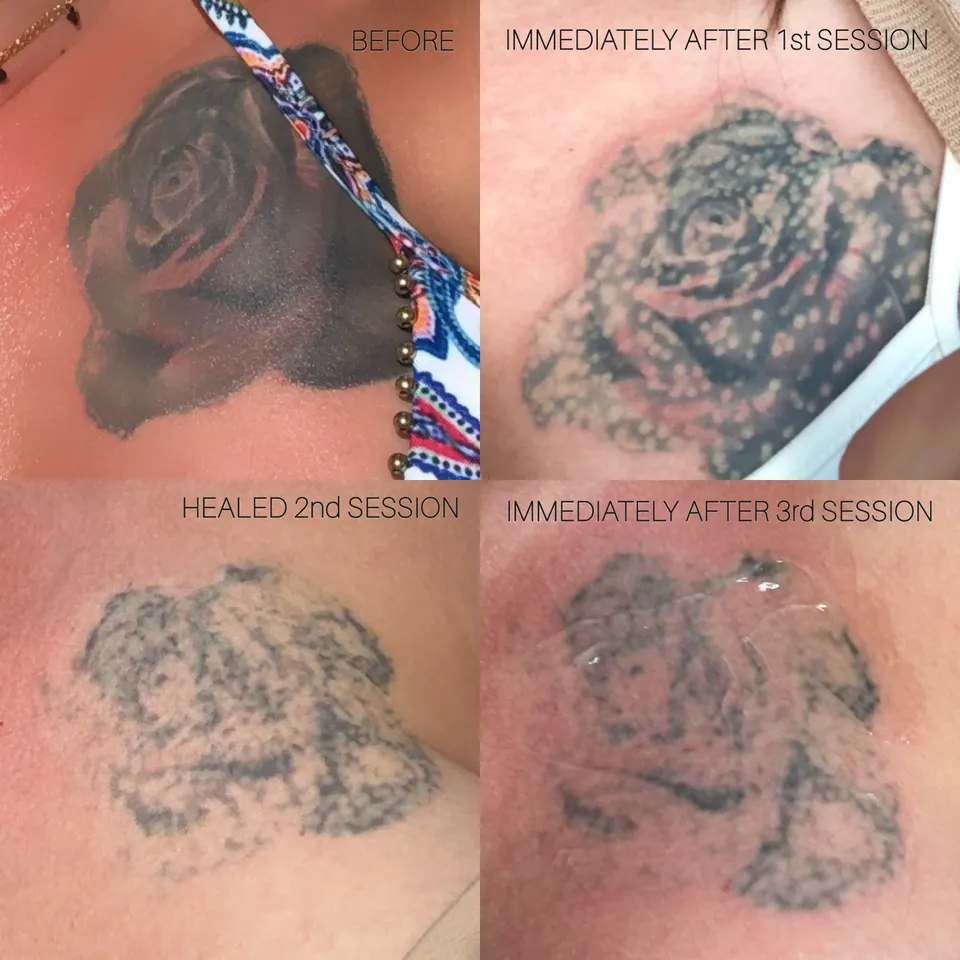Tattoo laser removal, stages labelled in the image