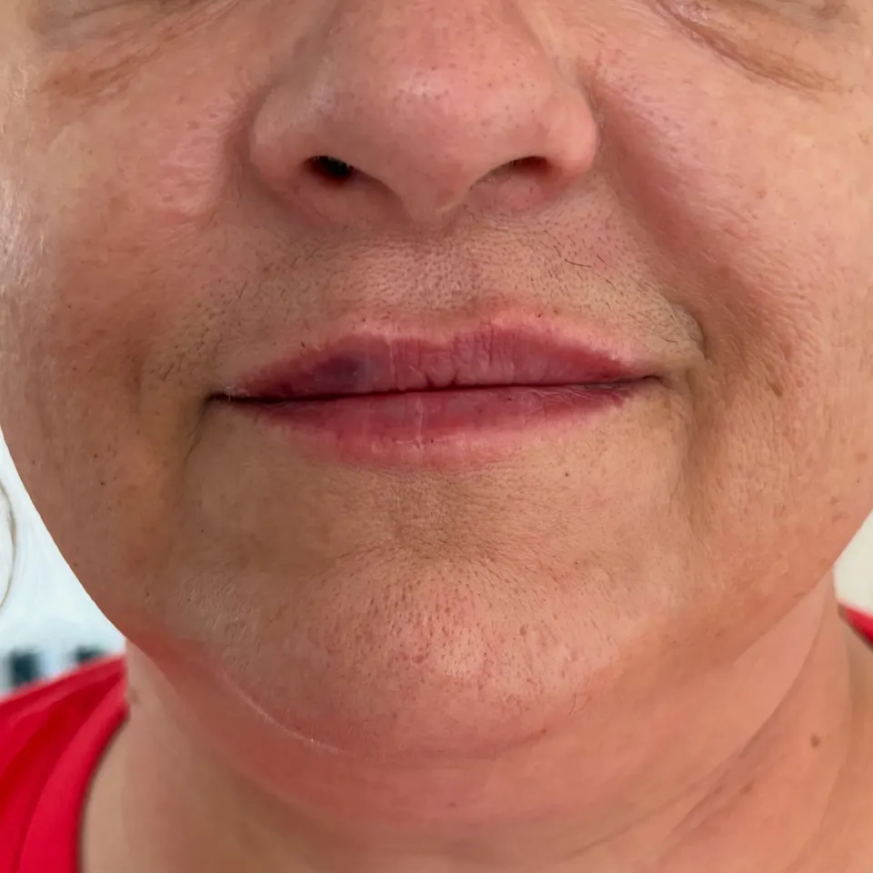 Lip enhancement for a mature client