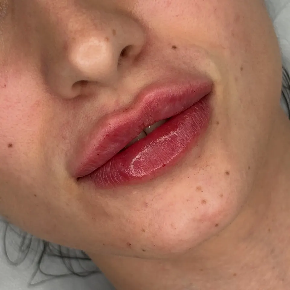 Lip enhancement, definition and volume